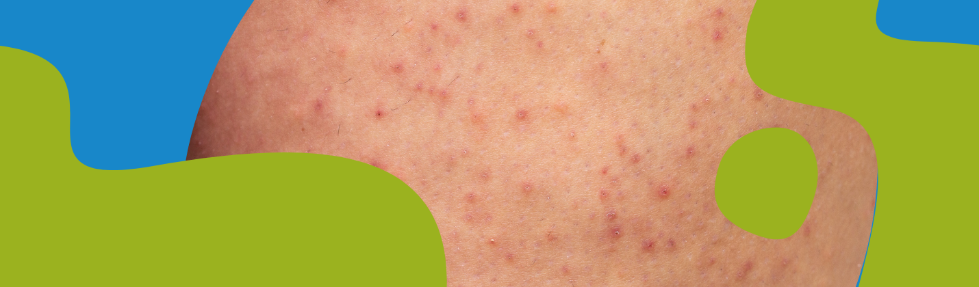 Folliculitis: Causes, Symptoms & How to Prevent It